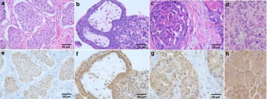 PAC-1, the first anti-cancer agent, has shown great promise in human cancer clinical trials